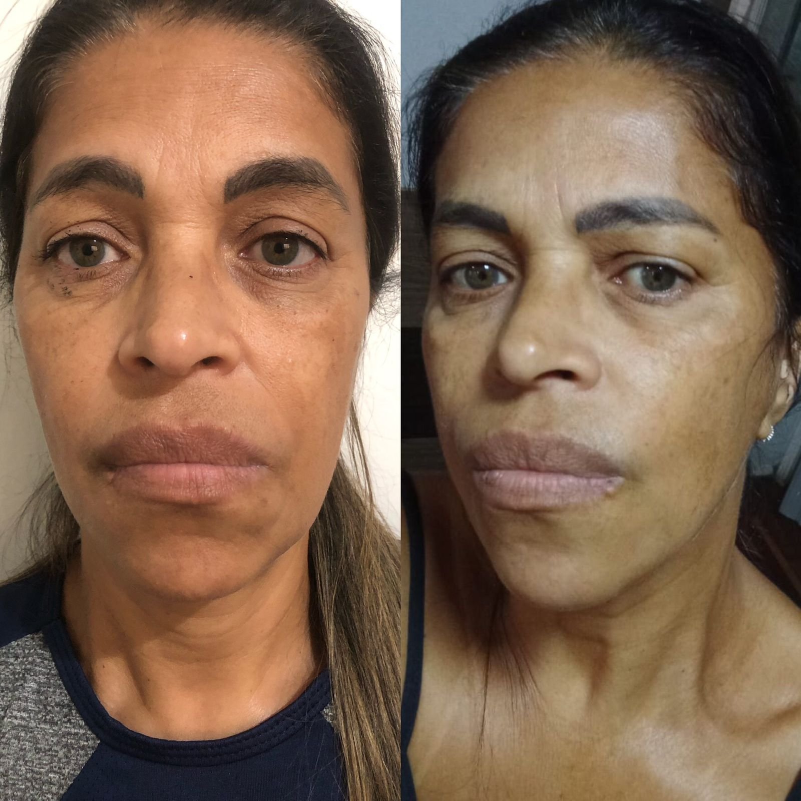 Resultado Facial