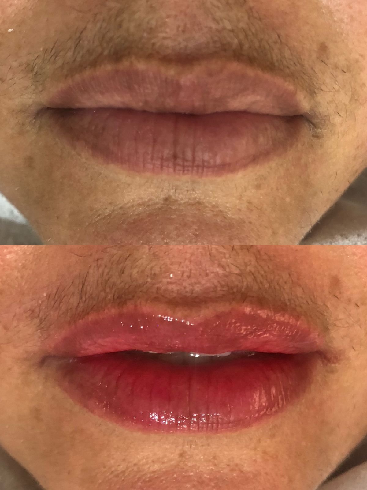 Preenchimento Labial